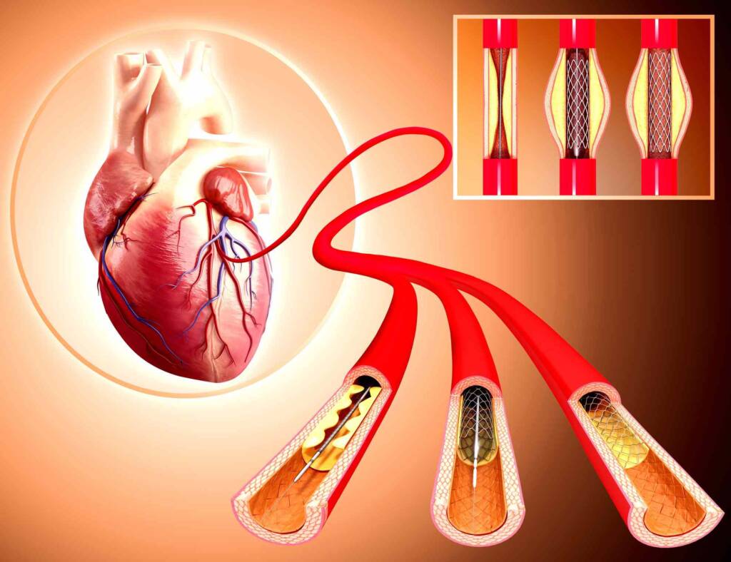 Peripheral Angiography