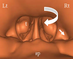Virtual Endoscopy