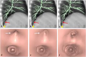 Virtual Bronchoscopy